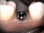 Implantat mit Heilungskappe
