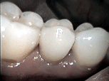 Auf dem Implantat eingesetzte Krone Auf dem Implantat eingesetzte Krone